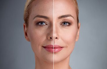 face fat graft لیفتینگ صورت در شیراز
