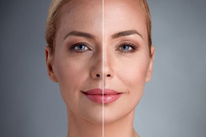 face fat graft لیفتینگ صورت در شیراز