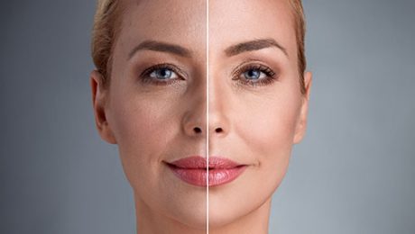 face fat graft لیفتینگ صورت در شیراز